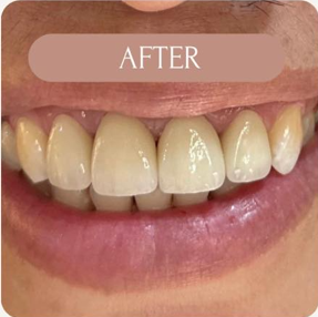 Orthodontic Result