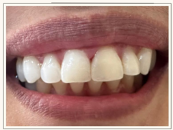 Diastema Closure